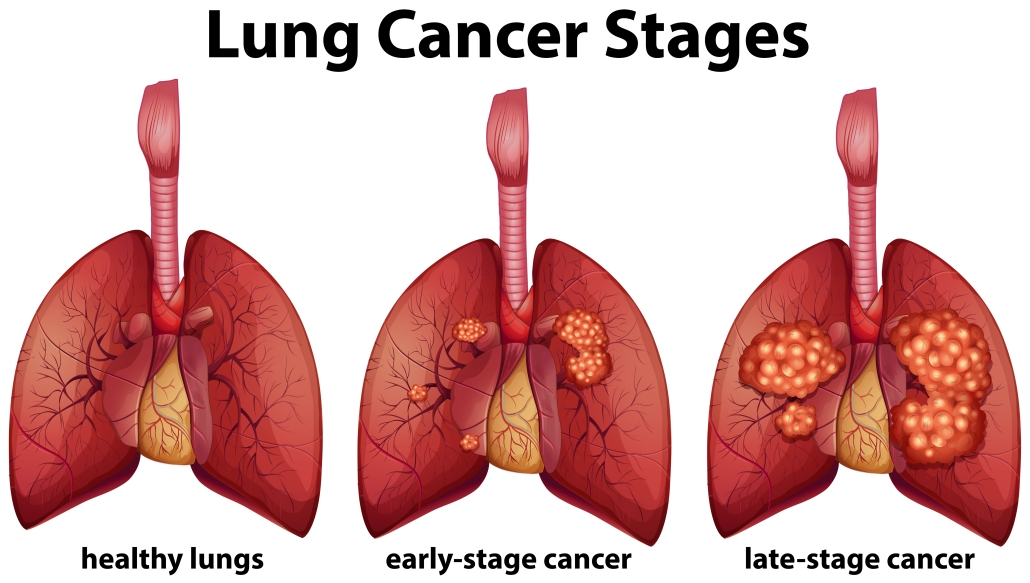 Stages-of-Lung-Cancer-1-1030x583-1.jpeg